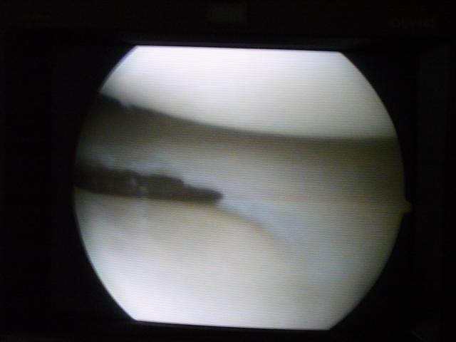 Travel - Bolivia - Knee Operation